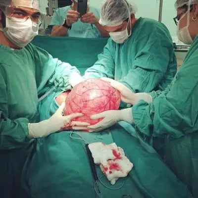 Let’s Talk Ovarian Dermoid Cysts: What Are They Plus Conventional and Natural Remedies to Manage Cysts